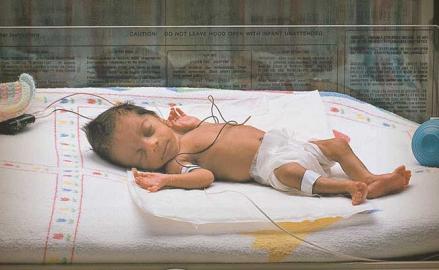  Pregunta y respuesta sobre bebés prematuros